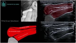 Sonographische Darstellung der kurzen Nackenmuskeln [upl. by Asta]