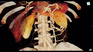 Intestinal malrotation CT Scan： 腸捻転 [upl. by Adnar]