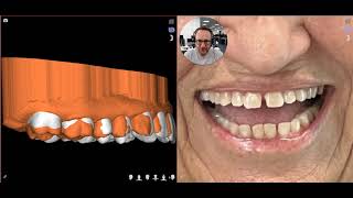 Correcting Canted Smiles with Aligners and the 3 ingredients to successfully intrude posterior teeth [upl. by Anpas]