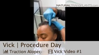 High Hairline Solution Hair Transplant Transforms Patients Hairline  Dr Blumenthal Vick [upl. by Anauq]