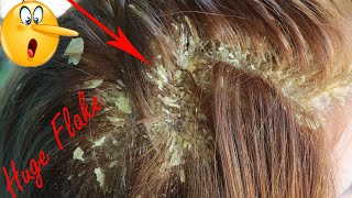 Big Flakes Of Dandruff On Scalp Removal in Hair Itchy Scalp Psoriasis Treatment  262 [upl. by Bremble785]