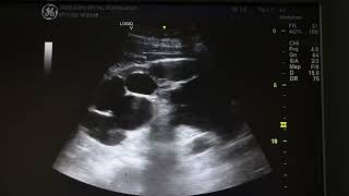 Ultrasound of spermatocele [upl. by Novaj]