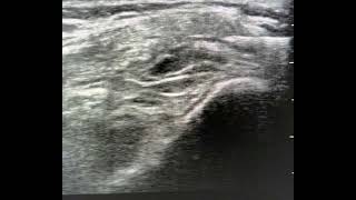 ultrasound guided knee joint injection llateral suprapatellar approach example 2 [upl. by Andeee666]