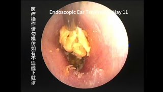 Cerumen embolism caused by cotton swabs [upl. by Helaine]