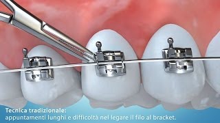 Video Animazione 3D tecnica di allineamento dentale con bracket [upl. by Zeralda]