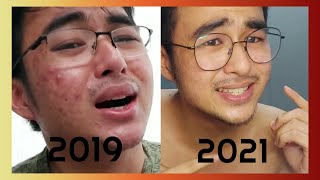 2021 SKINCARE ROUTINE FOR ACNE PRONE AND SENSITIVE SKIN PHILIPPINES  Brands w Prices  KevInSeries [upl. by Ytsirk448]