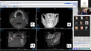 PreXion Online Presentation quotReading and Diagnosing CBCT Imagesquot [upl. by Dyoll]