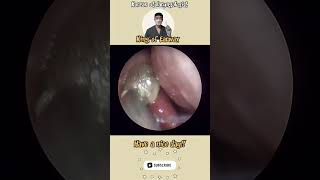 귀지형 콧물 부비동염 축농증 비염 코청소 이비인후과 rhinorrhea rhinitis sinusitis asmr ENT ENTdoctor [upl. by Lipp]