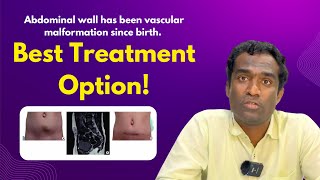 vascular malformation treatment in Hyderabad Dr Shaileshkumar at CitiVascularCentre  malformation [upl. by Airotahs]