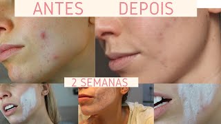 ANTES E DEPOIS ARGILA PARA TIRAR MANCHAS  Bruna Harmel [upl. by Azzil809]