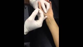 Opponens Pollicis Dry Needling [upl. by Rene514]