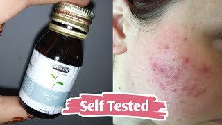 TEA TREE OIL FOR ACNE amp SCARS Self Tested [upl. by Kcin]