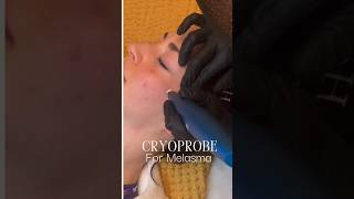 Cryoprobe pen for Melasma spots removal Before and after video and photos cryoprobe melasma [upl. by Letha337]