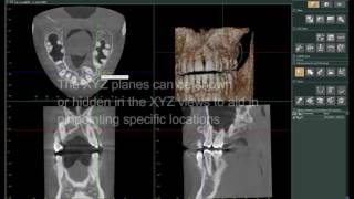 Dental TI Presents iDixel and the Morita R100 Navigating a 8x10 FOV [upl. by Woll940]