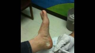 Placing a Cortisone Injection into the Plantar Fascia [upl. by Shaner127]