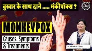 MONKEYPOX क्या है और कैसे फैलता है  Causes Symptoms amp Treatment  MPOX Virus in India [upl. by Napra]