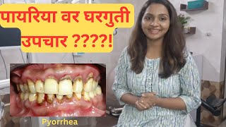 पायोरिया चे कारणे लक्षणे आणि उपचार  Pyorrhea  Causes Symptoms and Treatment [upl. by Vita]