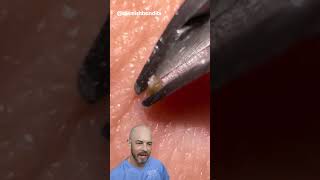 This ingrown hair removal is short and sweet credit blemishbandits on TT doctor satisfying [upl. by Davey]