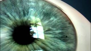 Laser Iridotomy for Angle Closure Glaucoma [upl. by Boelter666]