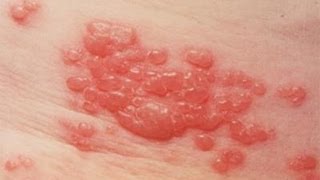 DermTV  Shingles  Herpes Zoster DermTV Epi 425 [upl. by Helmut427]