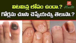 విటమిన్ల లోపమా గోర్లను చూసి చెప్పేయచ్చు  Vitamin Deficiency Can be Noted by Nails  YOYO TV Health [upl. by Tammi604]