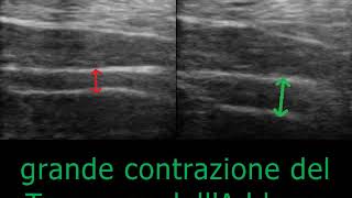 Terapia Manuale Ecoguidata  Attivazione Muscolare del Trasverso [upl. by Schmitz]