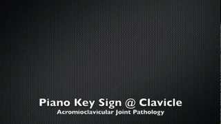 Piano Key Sign Clavicle [upl. by Calvin918]