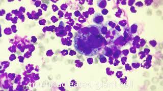 Multinucleated giant cells in cytology [upl. by Anitsahs]