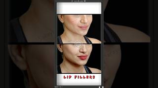 Get Fuller Symmetrical Lips By Dr Adarsh Tripathi  Sarayu Clinics fillers [upl. by Lakym]