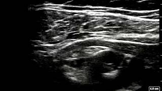 Ultrasoundguided Infraclavicular block  completed in 90sec [upl. by Madigan]