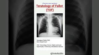 Teratology of Fallot  Boot shaped heart  viralvideo teratologyoffallot radiology vsd [upl. by Fauch]