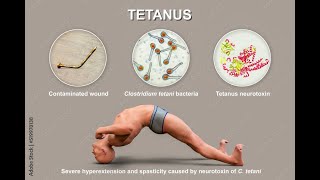 Tetanus  What is Tetanus  Cause symptoms treatment amp prevention of Tetanus [upl. by Ennovy462]