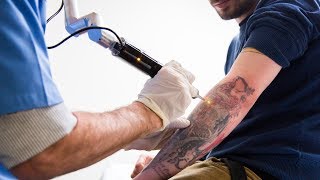 Tattoo Removal Laser Surgery [upl. by Naek189]