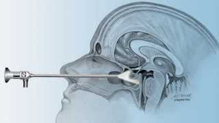 Pituitary Tumor Jims story  UC Brain Tumor Center [upl. by Delbert]