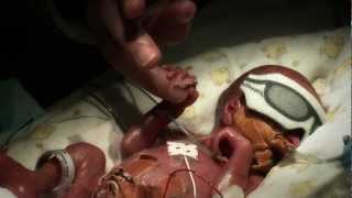 24 week premature baby  Tobys journey [upl. by Ailegra]