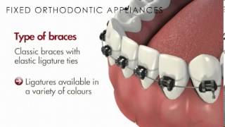 MalocclusionFixed Orthodontic AppliancesBraces [upl. by Aitnom]