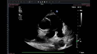 thrombus in LAA with DCM pectinate muscle [upl. by Aridatha]