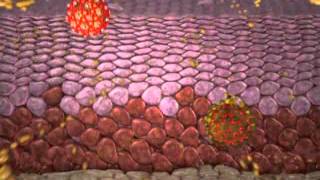 Cervical intraepithelial neoplasia [upl. by Zitvaa]