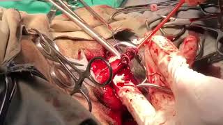 Heartworm Surgical Extraction  Caval Syndrome 62 heartworms extracted [upl. by Kalam912]