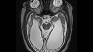 Periventricular Leukomalacia [upl. by Areht911]