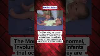 MORO Reflex Mororeflex hospital mbbs neetpg neet intership ytvideo ytshorts fmge short [upl. by Ranzini]