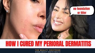 HOW I CURED MY PERIORAL DERMATITIS IN THREE 3 DAYS [upl. by Kessel]