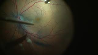 Fovea Sparing ILM Peeling for Vitreomacular Traction with Foveal Detachment [upl. by Altis]