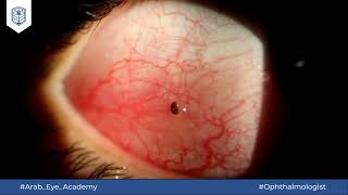 Educational Video 38 Conjunctival FB removal under slit lamp [upl. by Knighton]