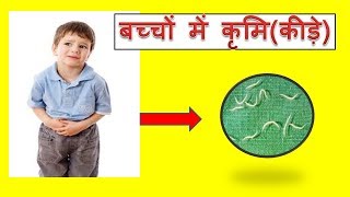 Stomach worms in kidsबच्चों में कृमिकीड़े [upl. by Nesahc]