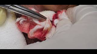 Post aural abscess incision and drainage  Drainage of abscess  Dr Hitesh Patel [upl. by Ralat]