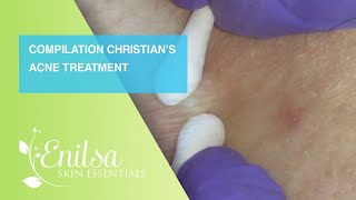 Compilation of Christian’s Acne Treatment [upl. by Raffaj]