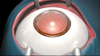 Cataract Surgery [upl. by Icat]