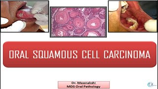 Oral Squamous Cell Carcinoma [upl. by Doran]