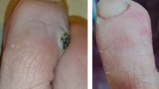 VERRUCA WART best way to get rid of viral verruca wart [upl. by Thesda]